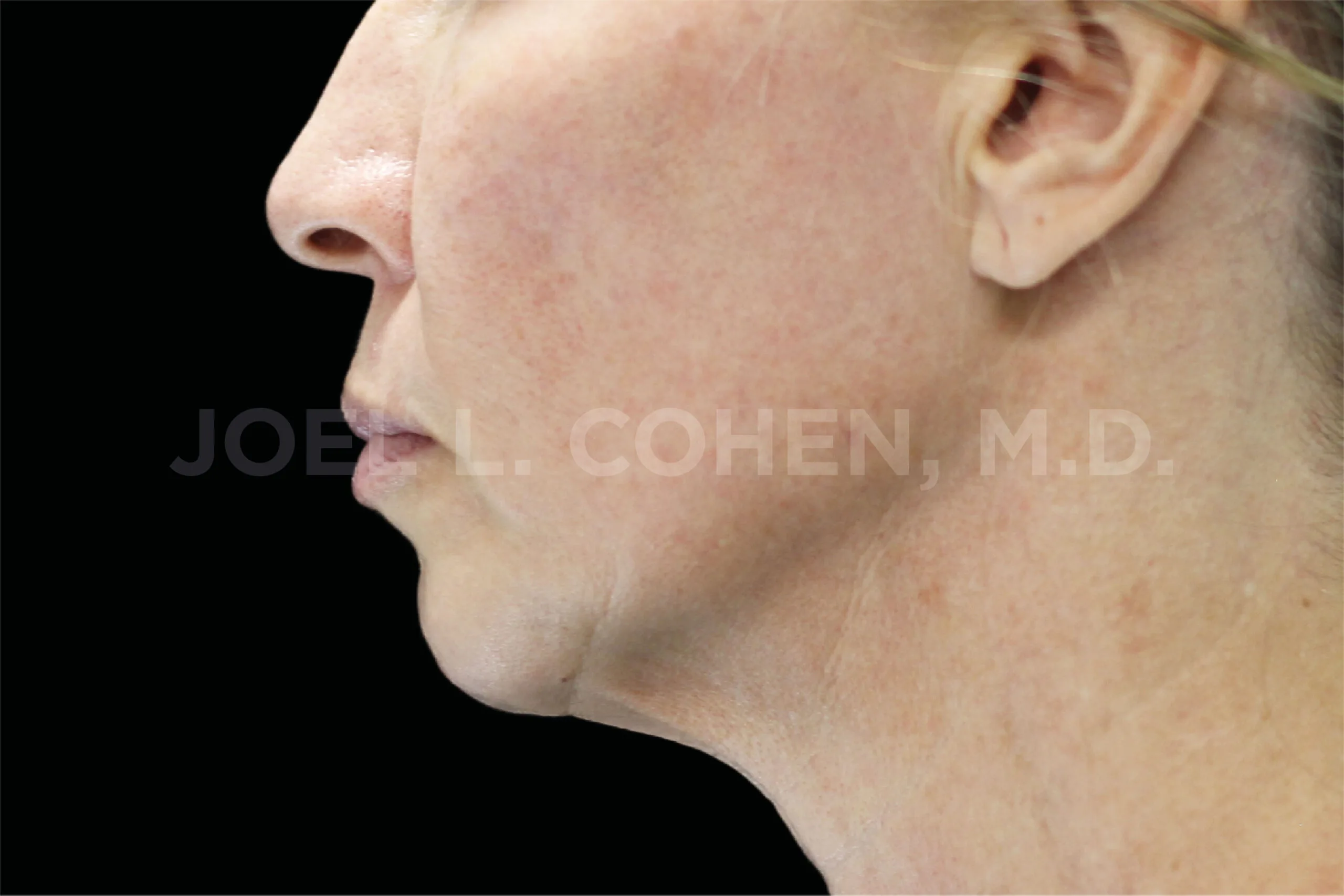 EMface facial toning Dublin - after photo of the jawline and neck in profile Jawline and neck in profile after EMface facial toning at our Dublin clinic