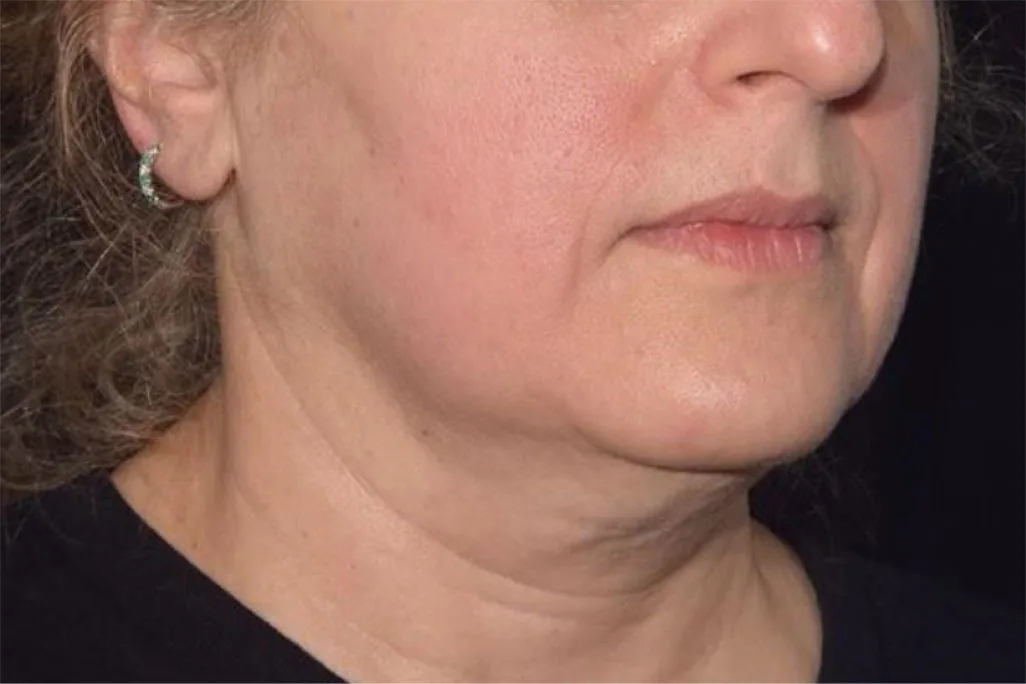 EMface facial toning Dublin - after photo of the jawline and neck Jawline and neck after EMface facial toning at our Dublin clinic
